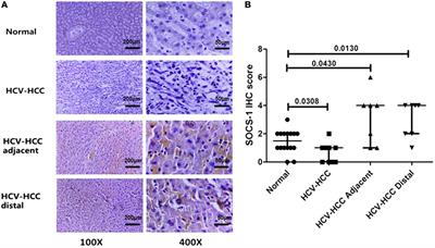 CpG Island Methylation of Suppressor of Cytokine Signaling-1 Gene Induced by HCV Is Associated With HCV-Related Hepatocellular Carcinoma